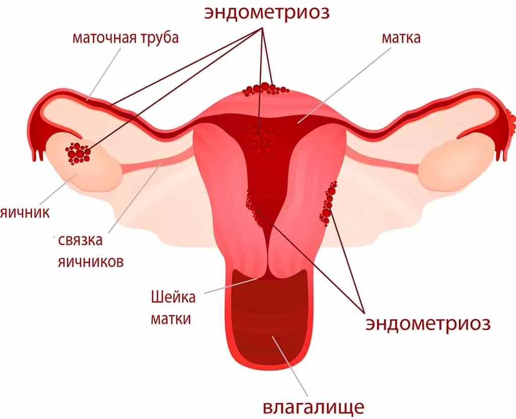 Эндометриоз матки: симптомы и лечение в клинике Репромед
